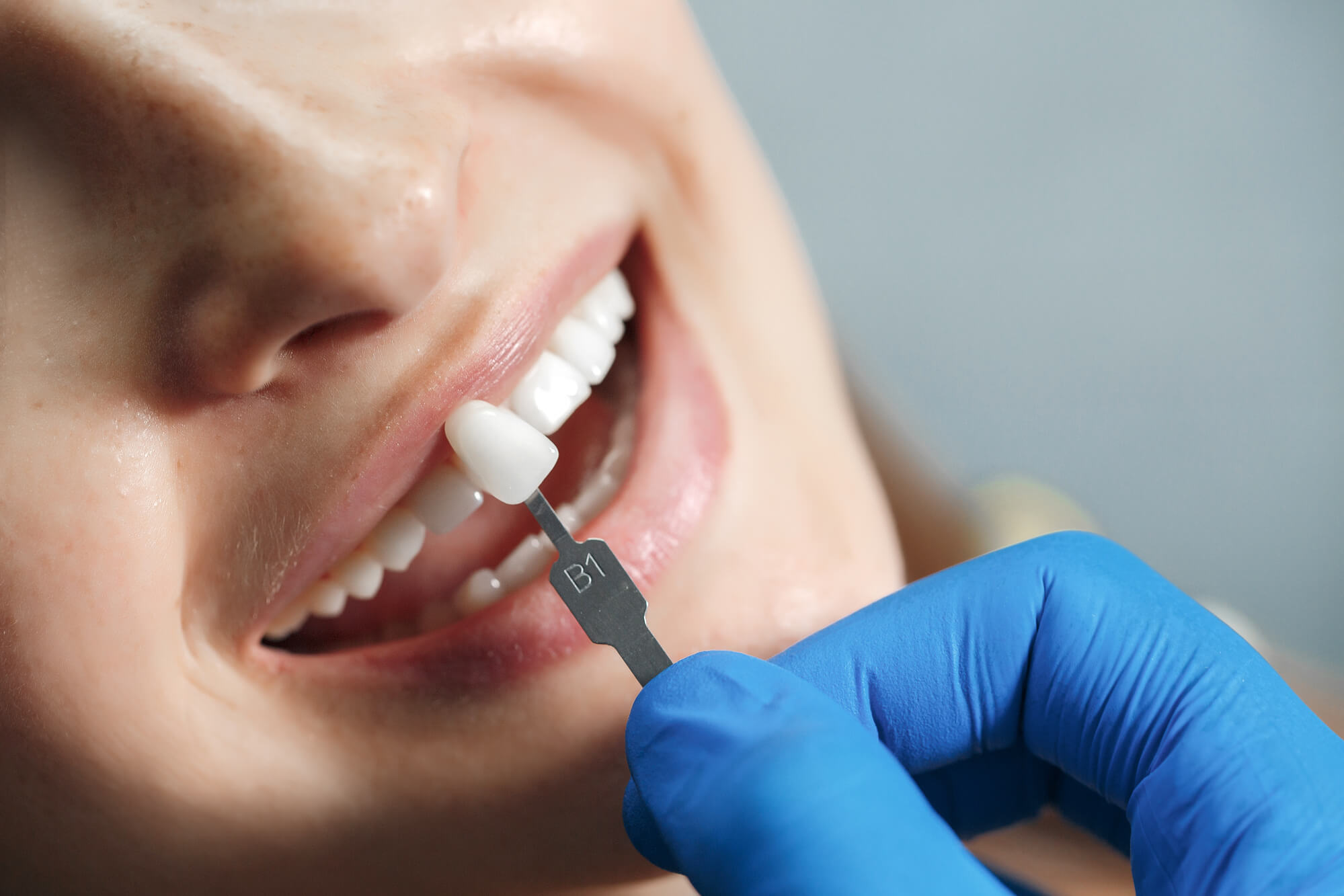 veneers Liverpool