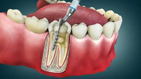 root canal treatment guildford