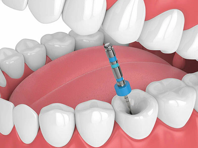 root canal treatment Granville
