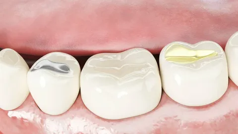 dental fillings Westmead